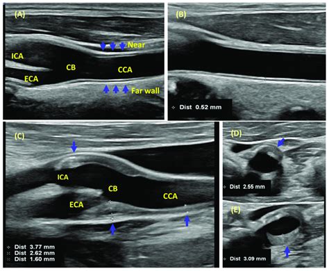 plaque scan carotid intima-media thickness testing or cimt|cimt vs carotid ultrasound.